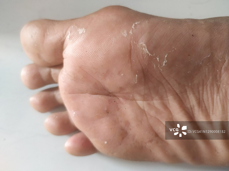 男子脚部皮肤因过敏化学反应而脱皮图片素材