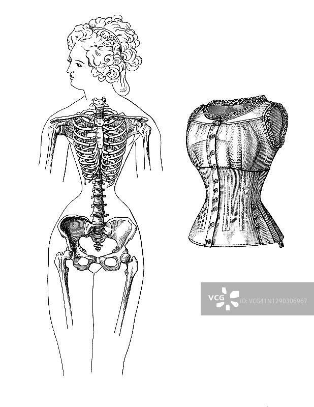 因穿紧身胸衣而变形的女性骨骼古版画插图图片素材