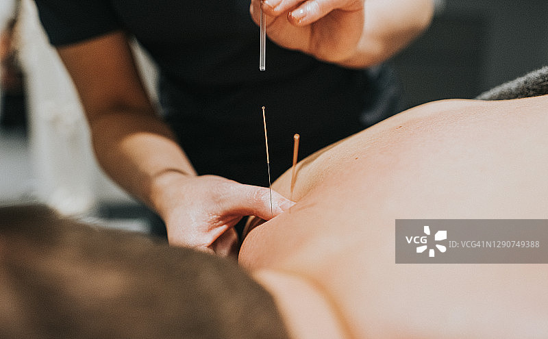 理疗师为患者上背部进行针灸图片素材