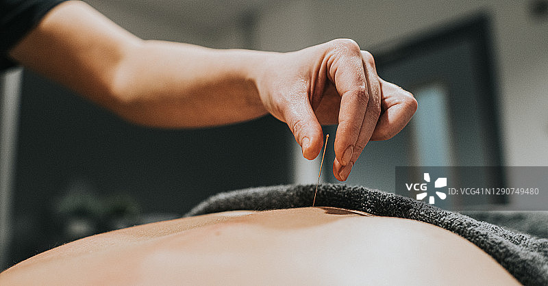 物理治疗师从皮肤拔出针灸针图片素材