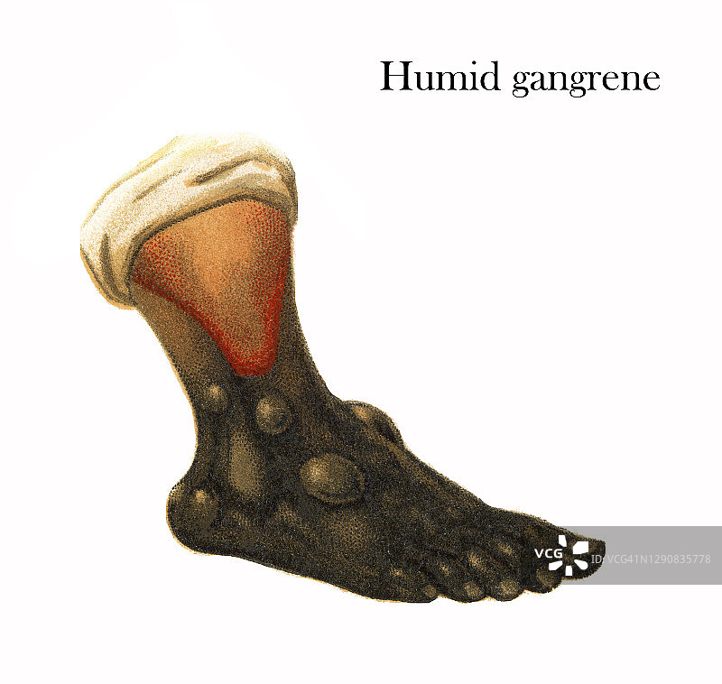 皮肤疾病，湿性坏疽老式雕刻插图图片素材