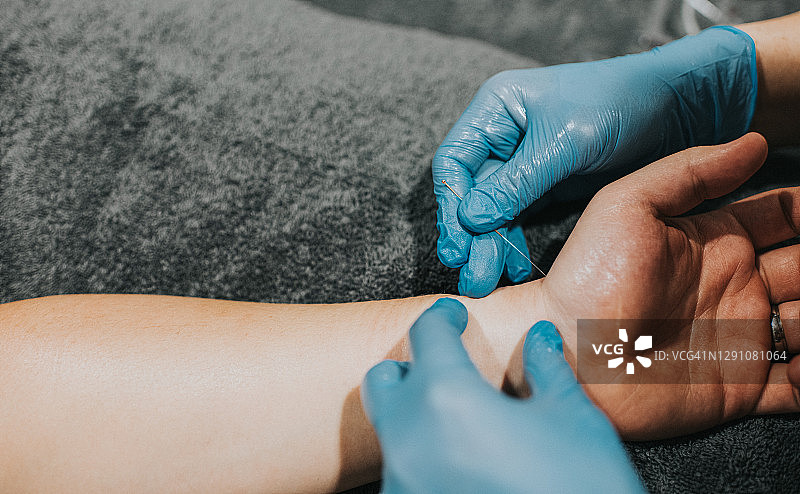 针灸师为病人手腕施针图片素材