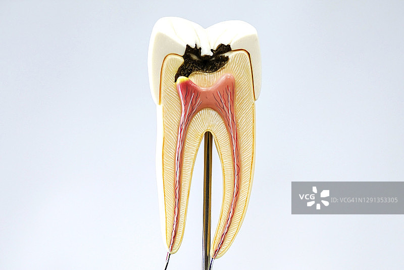 龋齿模型图片素材