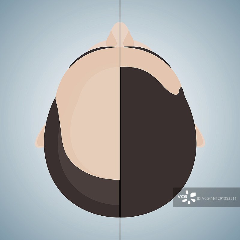 男性脱发治疗概念插图图片素材