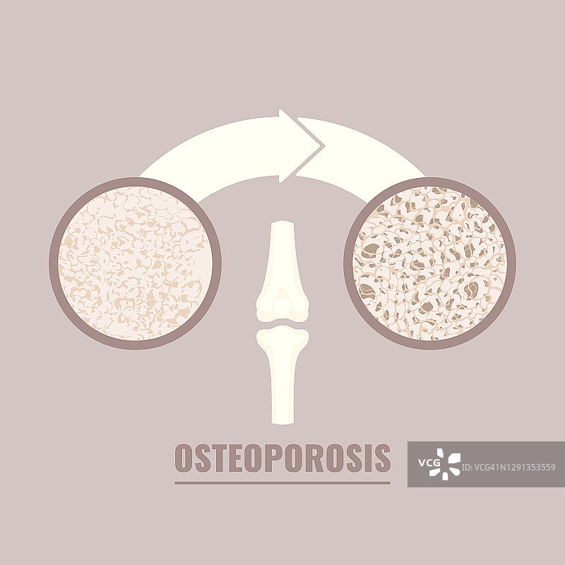 骨质疏松症概念图图片素材