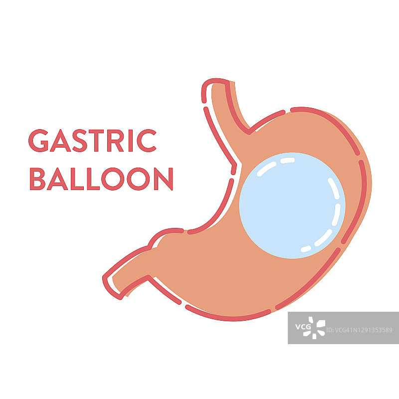 胃球囊插图图片素材