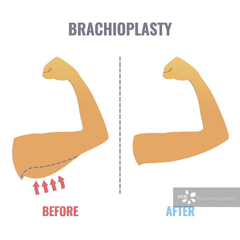 上臂整形术插画图片素材