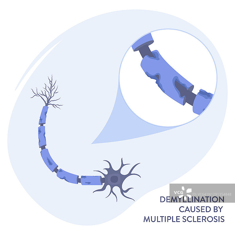 多发性硬化症插图图片素材