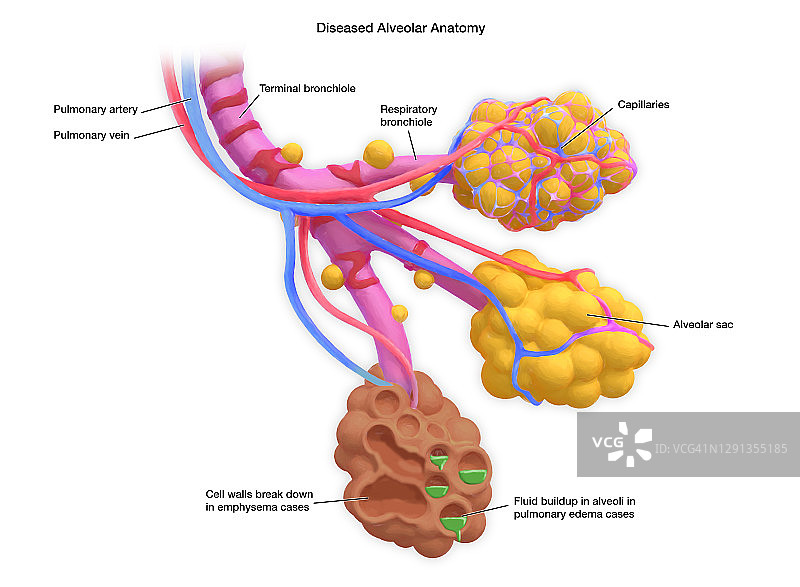 患病肺泡，图示图片素材