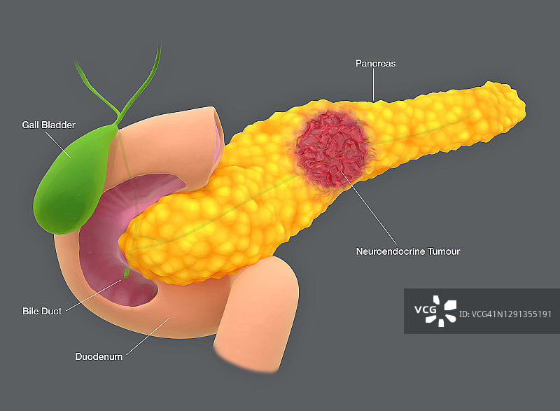 胰腺神经内分泌肿瘤插图图片素材