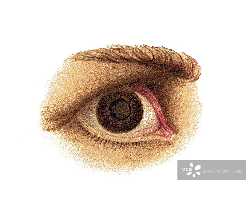 眼部感染和疾病、白内障（晶状体混浊）古老雕刻插图图片素材