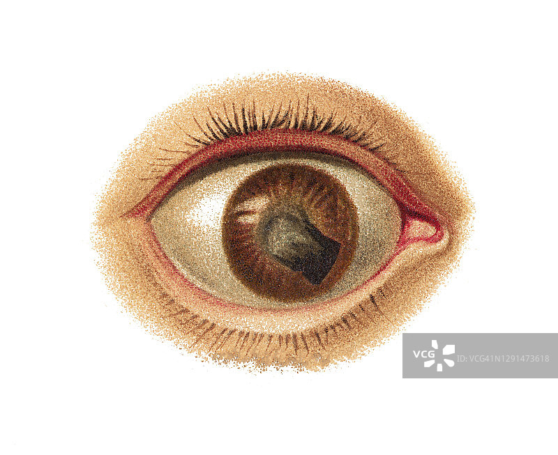 眼部疾病：中央角膜混浊与人工瞳孔旧版雕刻插画图片素材