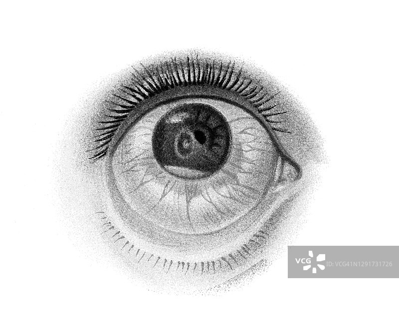 眼部感染和疾病古老雕刻插图：前房积脓性角膜溃疡图片素材