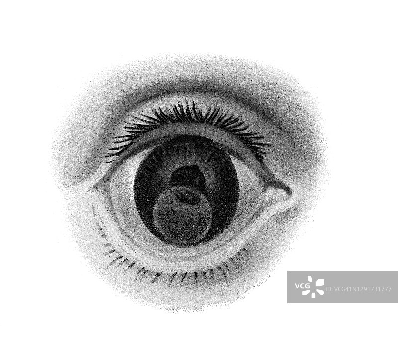 眼部感染和疾病古老雕刻插图，晶状体异位图片素材