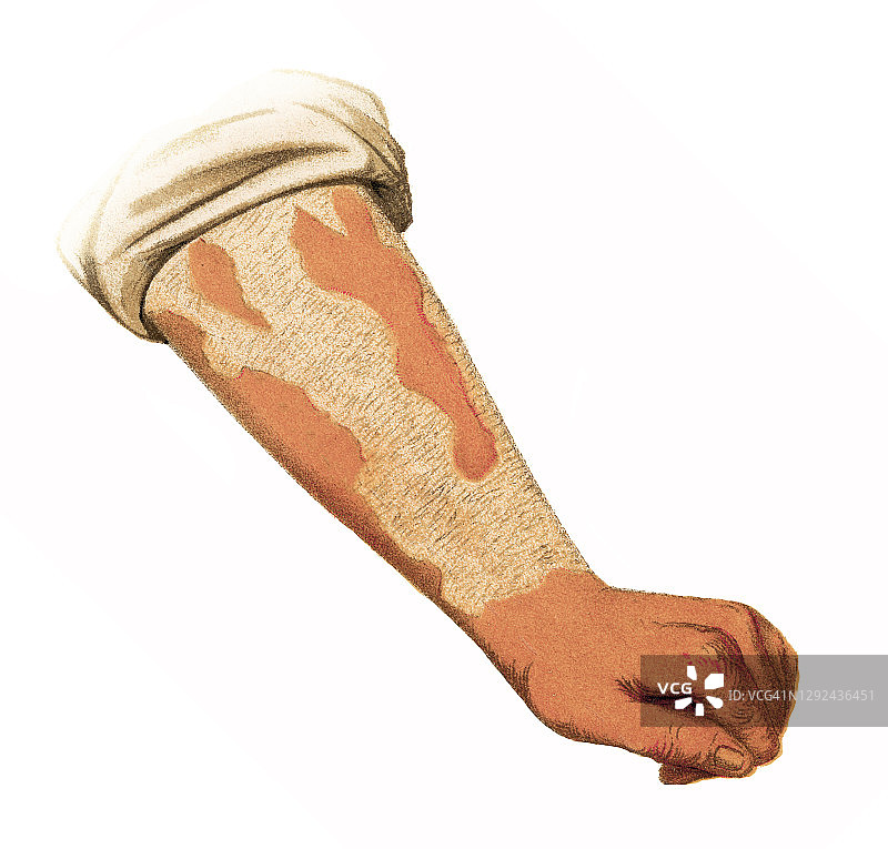 银屑病皮肤病古版画图片素材