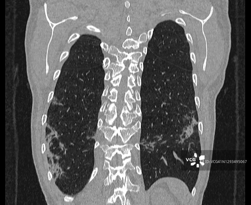 抗纤维化药物，纤维化，新冠后遗症，新冠后纤维化，新冠后ILD图片素材