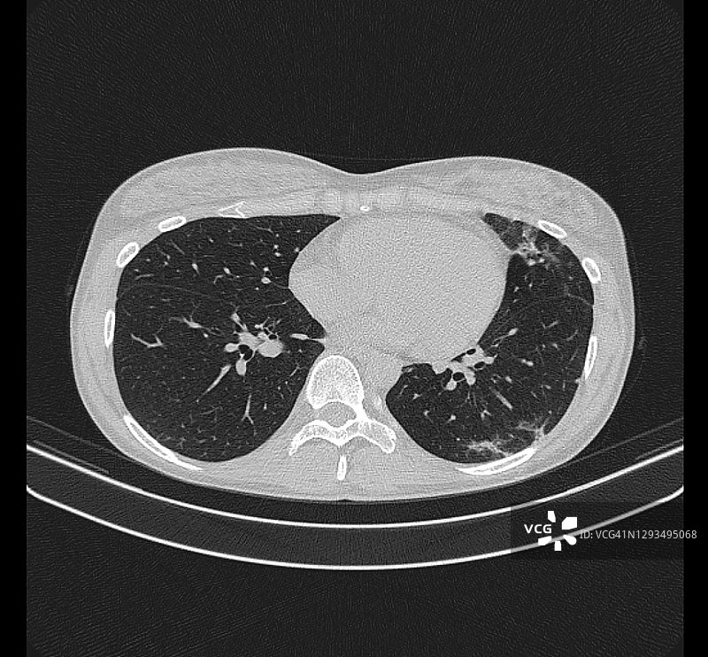 新冠肺炎确诊病例的胸部CT图片素材