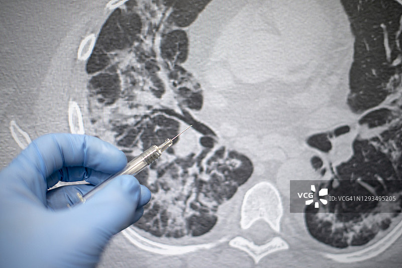 医生手中的新冠疫苗注射器，背景是病毒感染的肺部CT图片素材