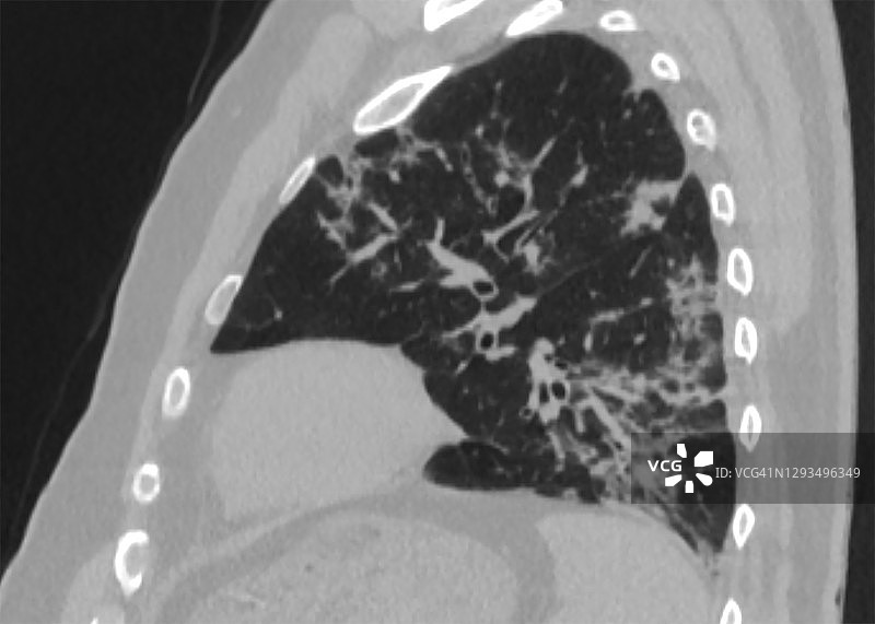 新冠肺炎的长期呼吸系统并发症，新冠肺炎后肺纤维化图片素材
