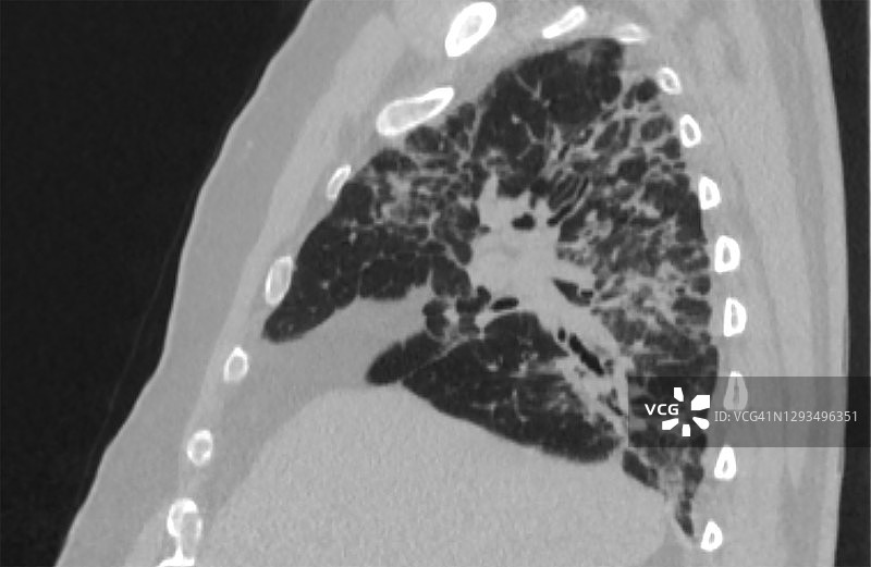 新冠肺炎长期呼吸系统并发症：新冠肺炎后肺纤维化矢状位图图片素材