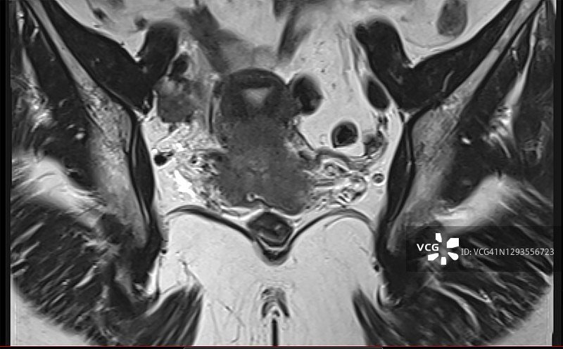 患有宫颈肿瘤（IIb期）的女性的磁共振图像图片素材