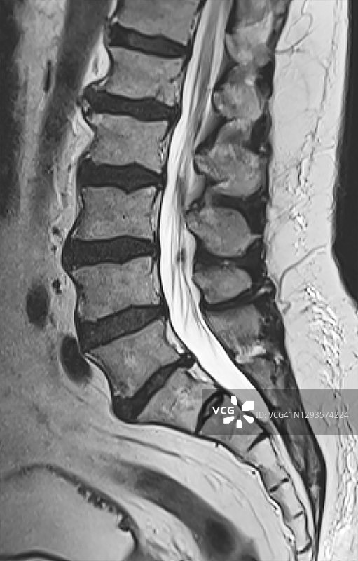 腰椎MRI（磁共振）下背部疼痛成像图片素材