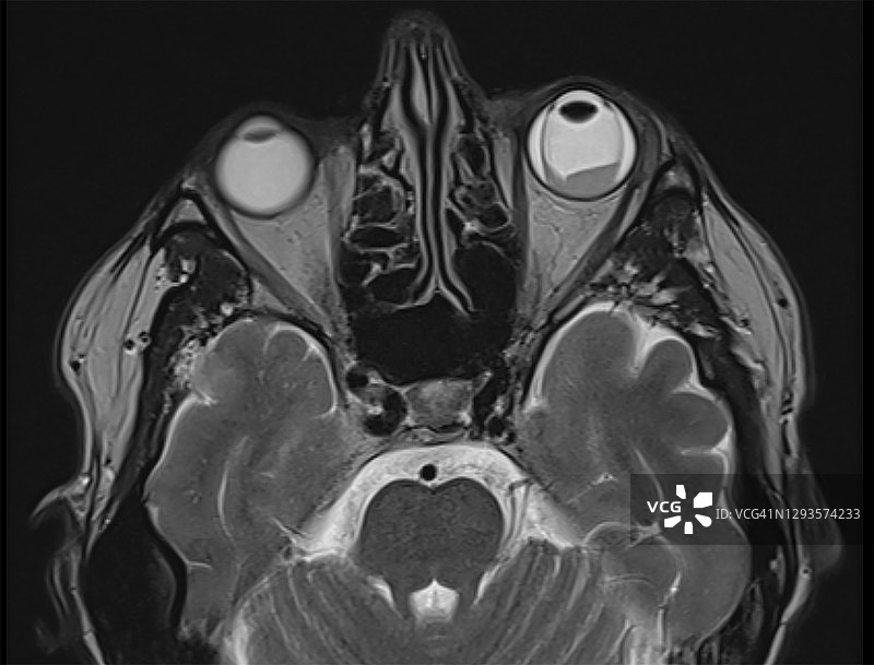 MRI图像显示左眼视网膜大面积脱落（T2轴位图像）图片素材
