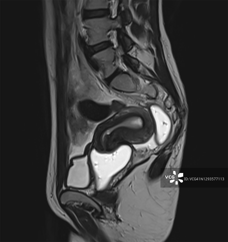 在女性盆腔病变MRI检查中进行直肠和阴道灌肠图片素材