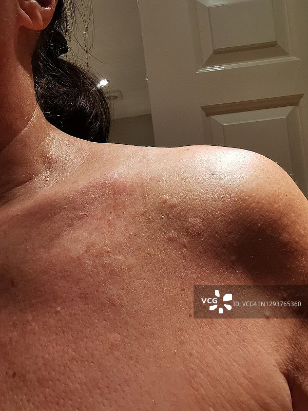 荨麻疹图片素材