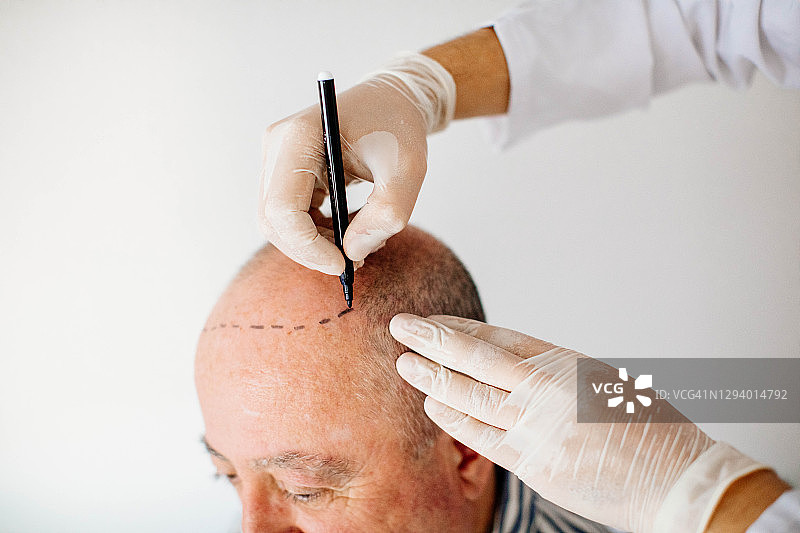 毛发移植图片素材