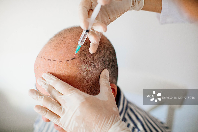 毛发移植图片素材