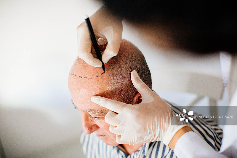 毛发移植图片素材