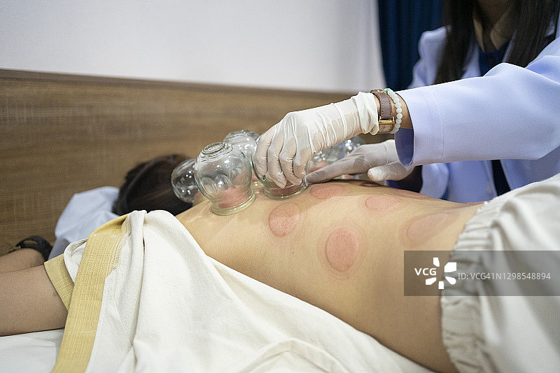 中国女医生用火进行拔罐疗法和中国传统替代物理疗法特写图片素材