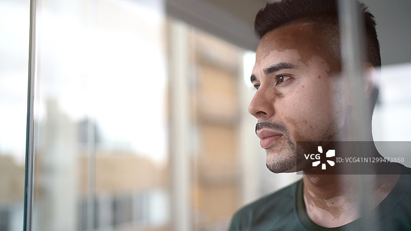 患有白癜风的年轻男人正在看窗外图片素材