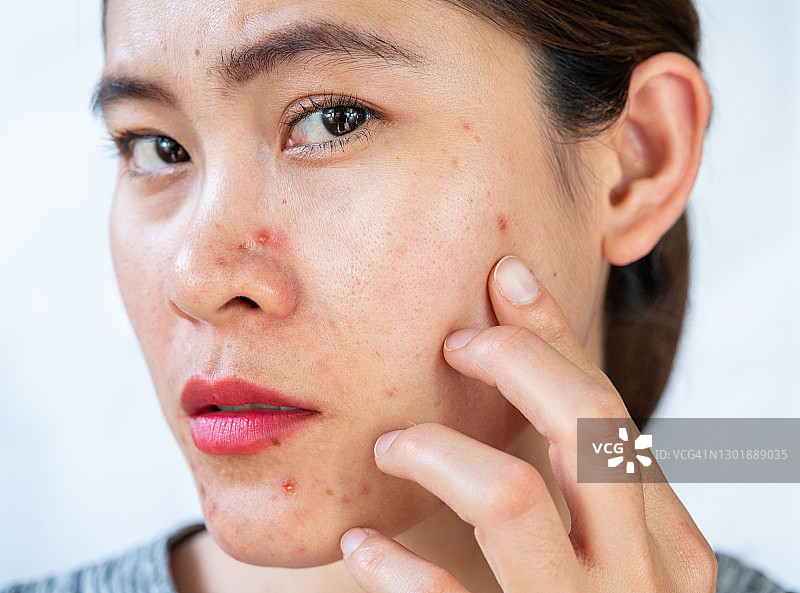 女人油性皮肤与脸部痤疮炎症图片素材