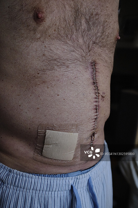 肠癌疤痕图片素材