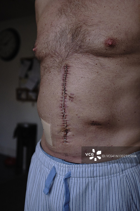 肠癌疤痕图片素材