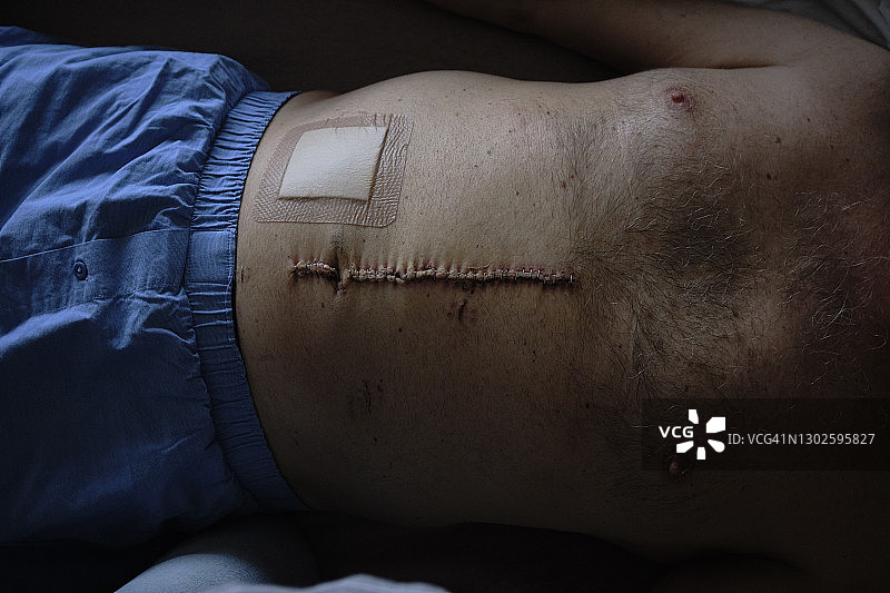 肠癌疤痕图片素材