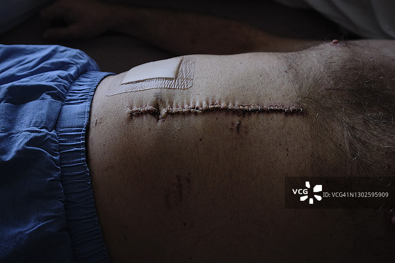 肠癌疤痕图片素材