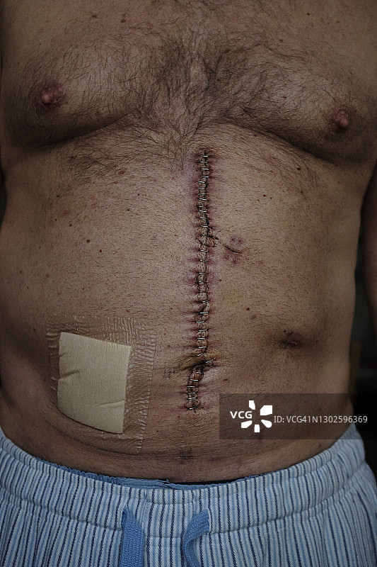 肠癌疤痕图片素材