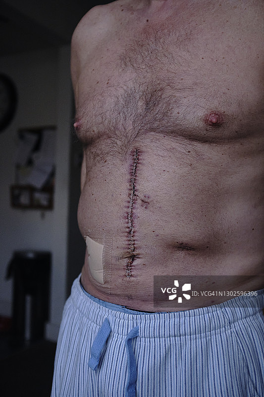 肠癌疤痕图片素材