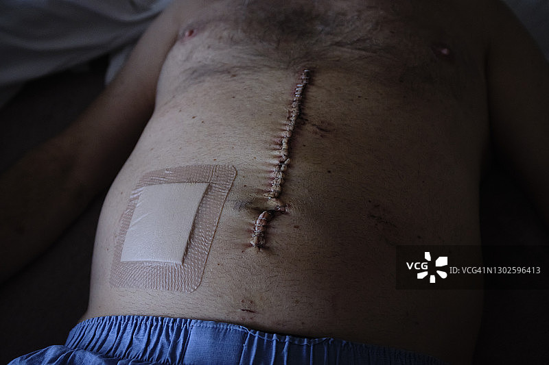 肠癌疤痕图片素材