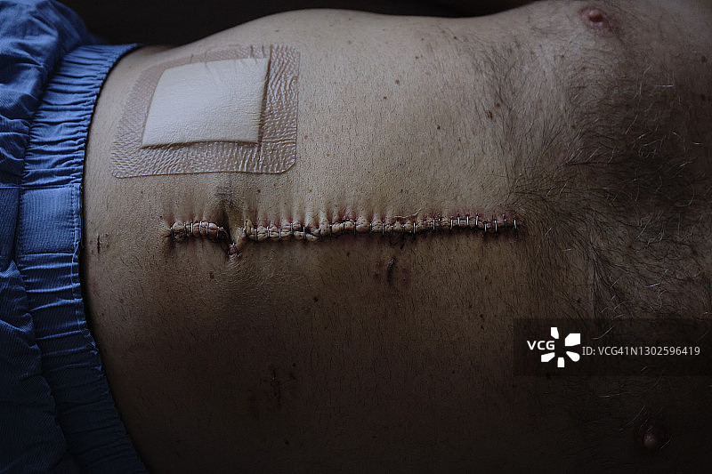 肠癌疤痕图片素材