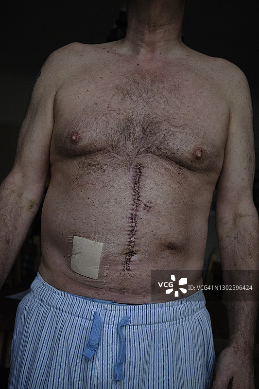 肠癌疤痕图片素材