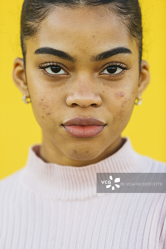 长有痤疮的年轻女孩图片素材