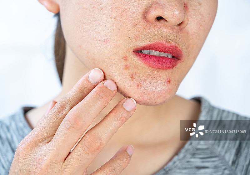 女人下半脸痤疮炎症图片素材