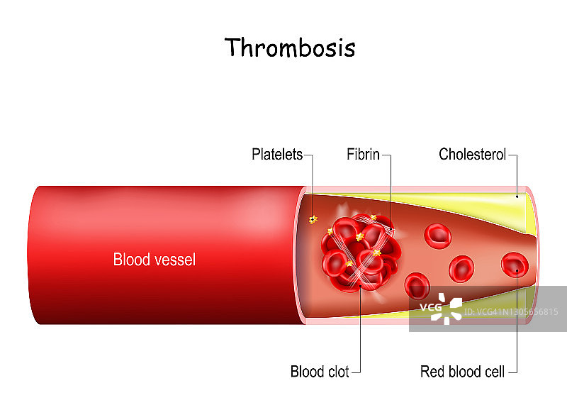 血管（动脉或静脉）中的血栓图片素材