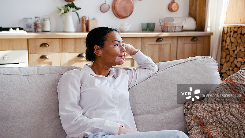 年轻拉丁裔女性患有白癜风，在厨房沙发上放松身心图片素材