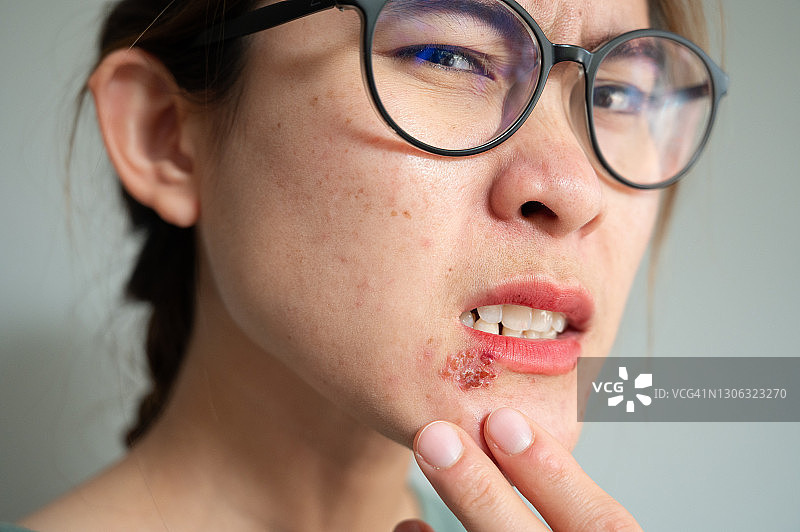 女性下唇唇疱疹疼痛特写图片素材
