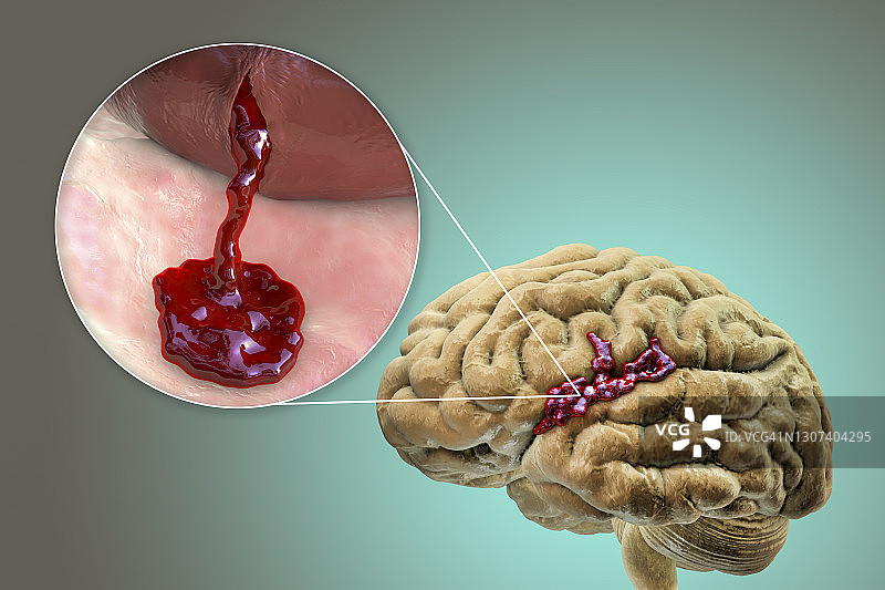 出血性中风插图图片素材